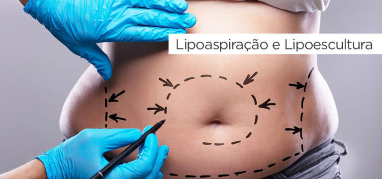 Lipoaspiração e Lipoescultura - Hospital Saint Helen